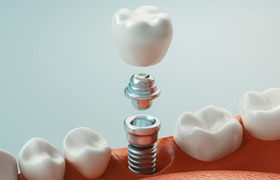 Illustration of a single dental implant
