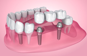 Illustration of an implant bridge