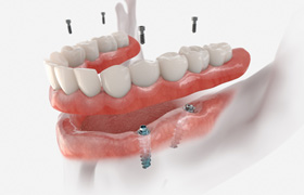Illustration of an implant denture